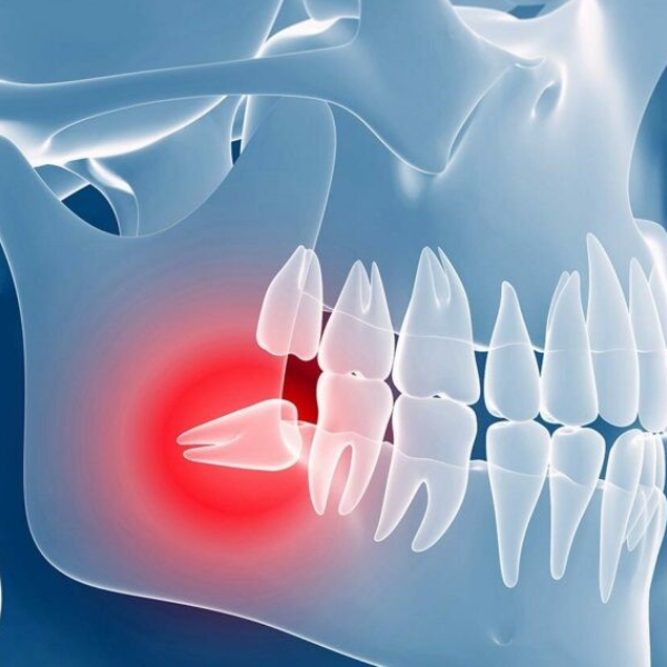 جراحی دندان عقل چرا و چگونه انجام می شود؟